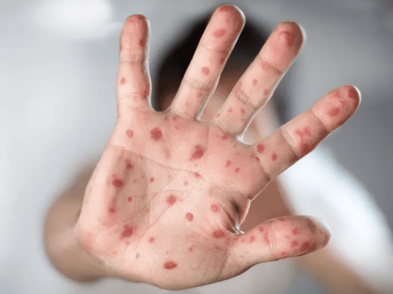 Argentina mantiene 11 casos confirmados de Mpox, incluido uno en Río&nbsp;Negro